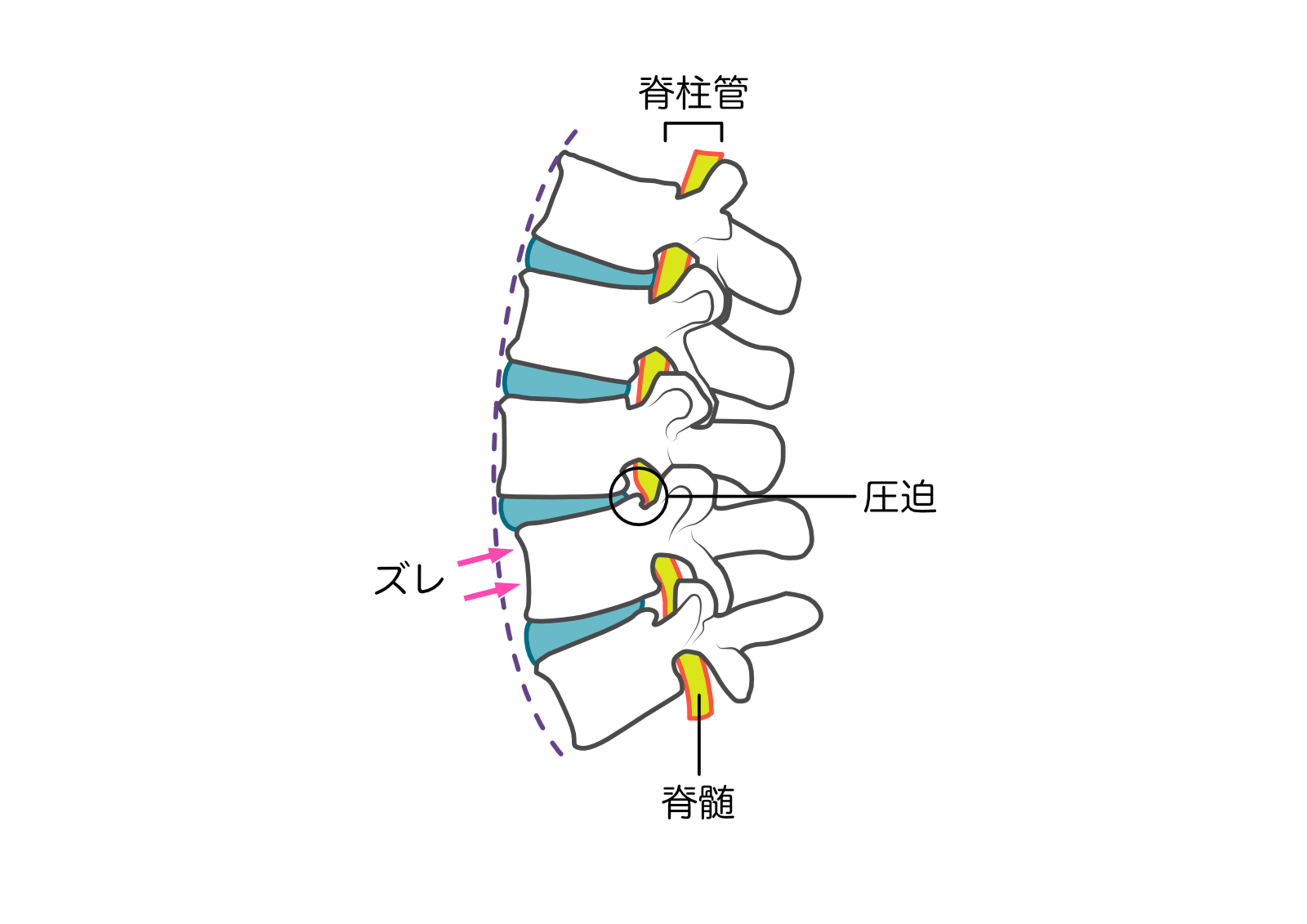 椎骨のズレ　脊柱管狭窄