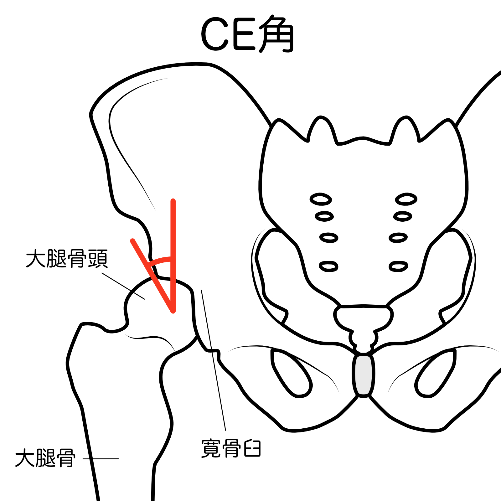 大腿骨CE角